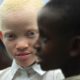 Ces maux qui collent à la peau des albinos
