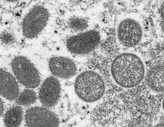 Santé en Afrique - Virus de Marburg: l'épidémie se propage en Guinée équatoriale.