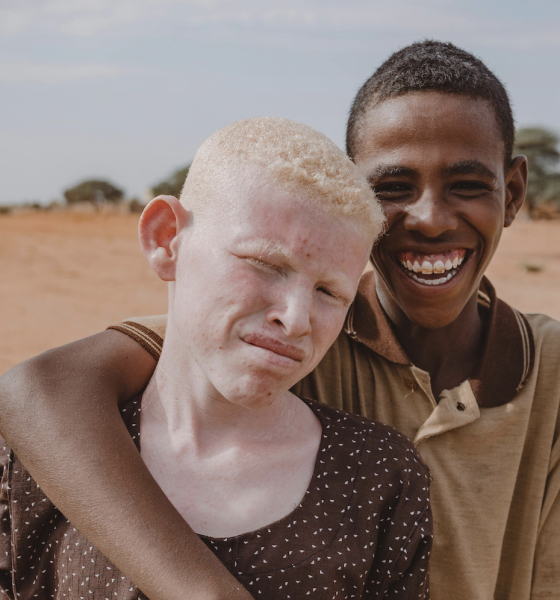 Ces maux qui collent à la peau des albinos
