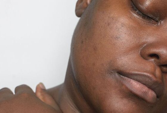 D’où vient l’hyperpigmentation des peaux noires?