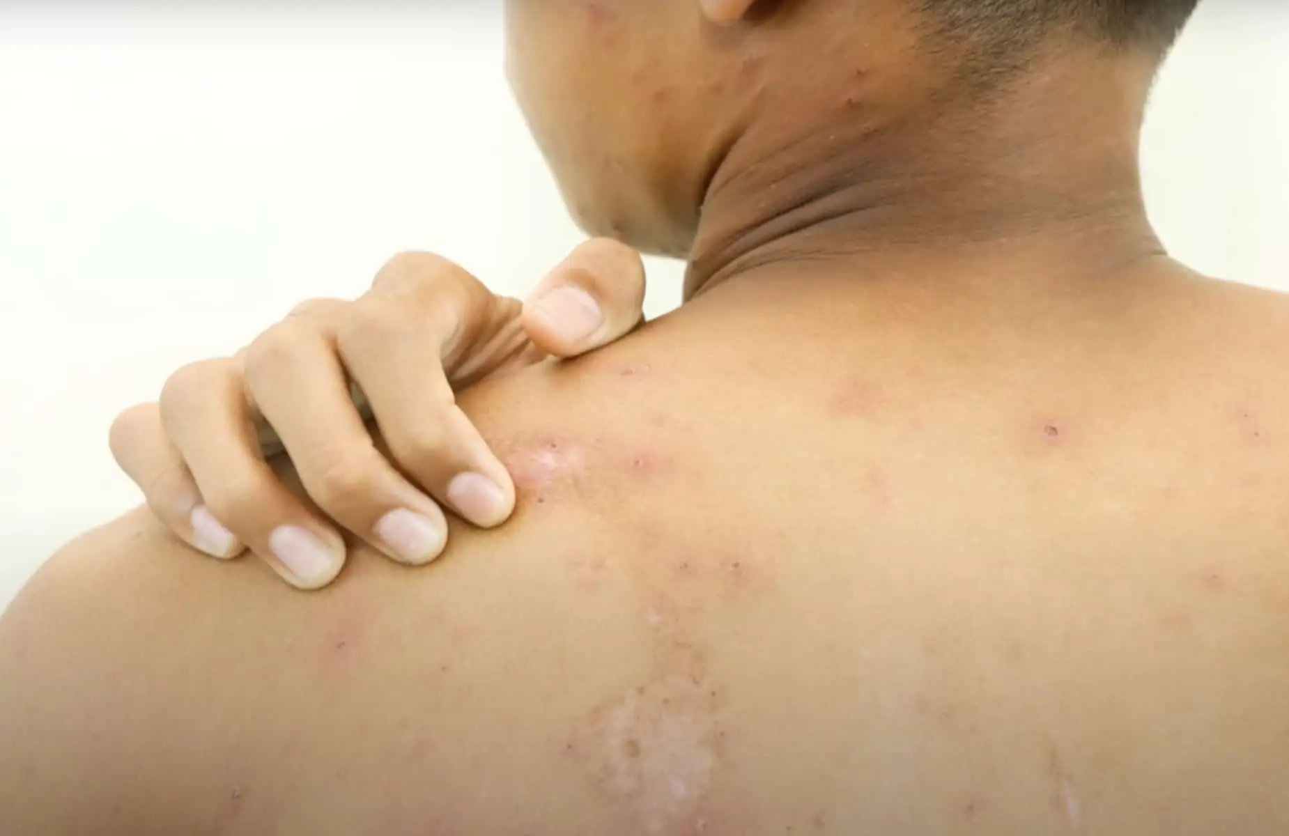 Les erreurs à éviter si votre enfant souffre de varicelle