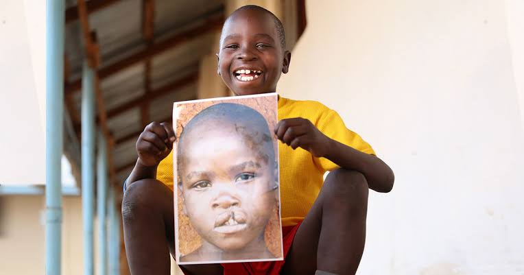 Fentes labio-palatines: à Goma, on répare le visage des enfants