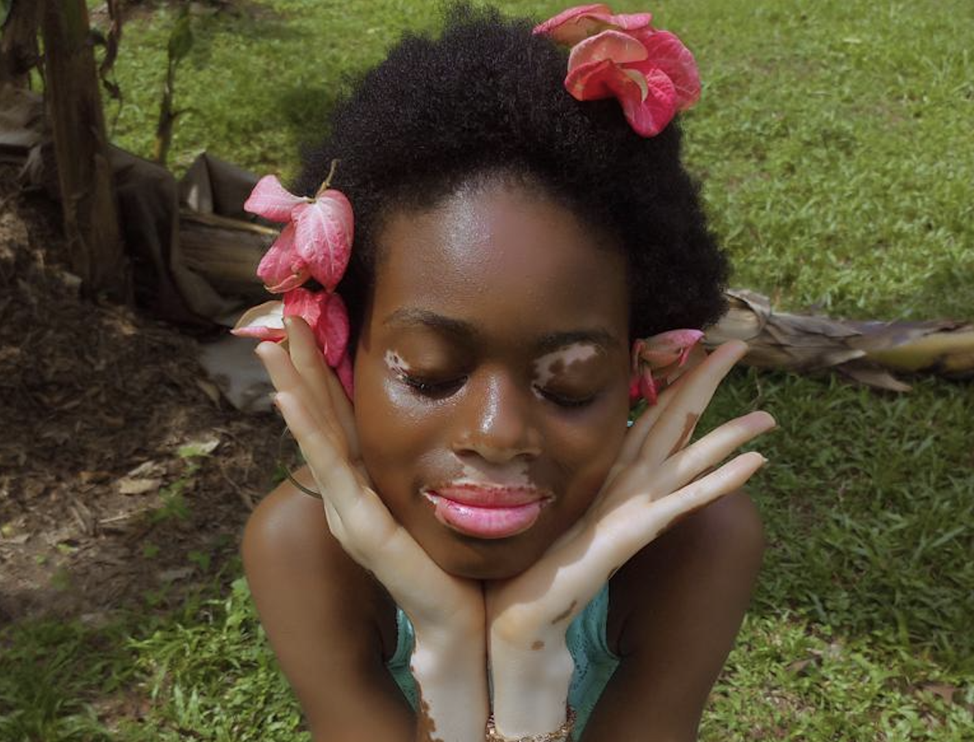 Vitiligo: comment transformer une déficience cutanée en body style