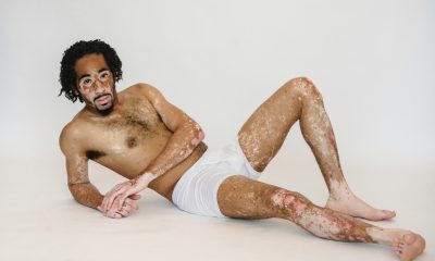 Vitiligo: comment mettre en valeur sa différence