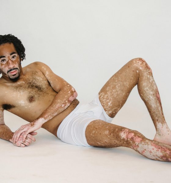 Vitiligo: comment mettre en valeur sa différence