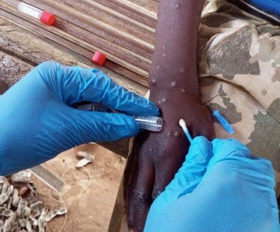 Mpox: quels sont les pays les plus touchés?