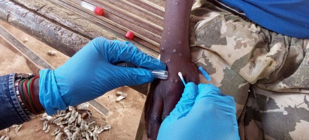 Mpox: quels sont les pays les plus touchés?